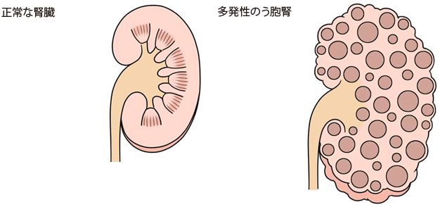 正常な腎臓/多発性のう胞腎