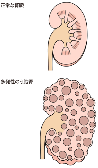 正常な腎臓/多発性のう胞腎